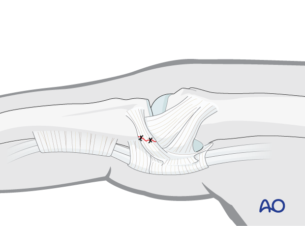 Repaired sagittal band lesion