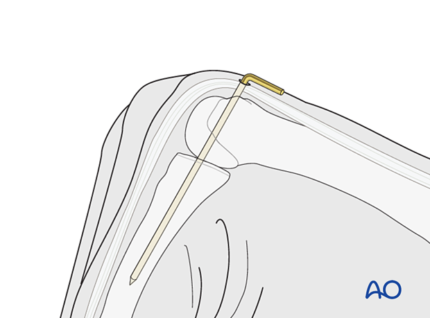 Transfixation of the 2nd metacarpophalangeal joint with a K-wire