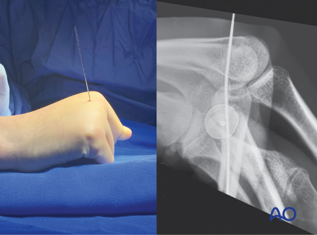 Transfixation of the 2nd metacarpophalangeal joint with a K-wire