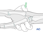 Closed reduction of a carpometacarpal joint dislocation