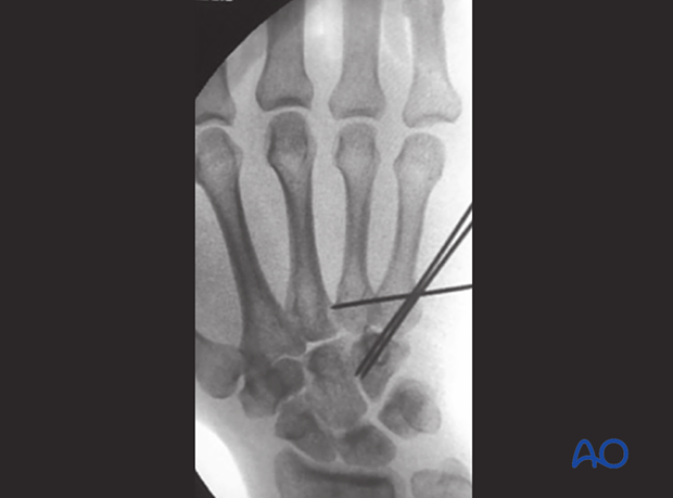 This case shows K-wire stabilization of the 5th to the 4th metacarpal base and the hamate.