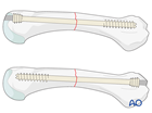 Intramedullary screw fixation of a transverse fracture of the metacarpal diaphysis