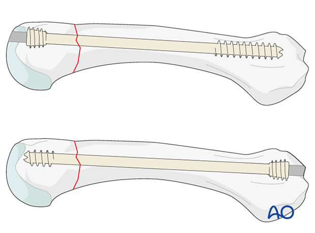 Intramedullary screw fixation of an extraarticular transverse fracture of a metacarpal head