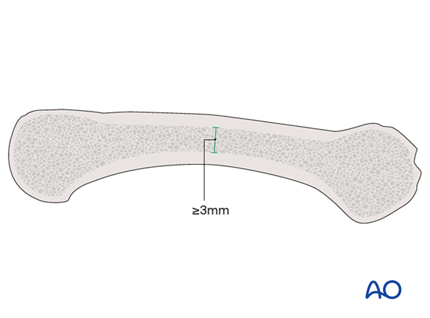 Longitudinal crosssection of a metacarpal showing the intramedullary space