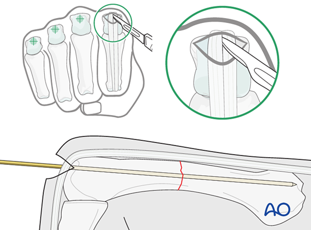 Intramedullary screw fixation of a transverse fracture of a metacarpal shaft - Guide wire insertion in a retrograde fashion