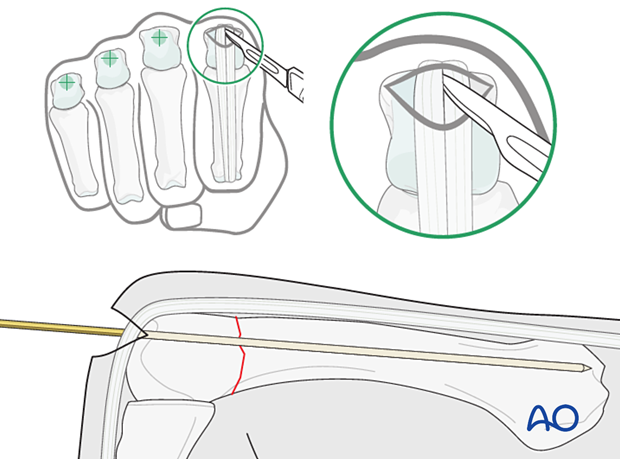 Intramedullary screw fixation of an extraarticular transverse fracture of a metacarpal head - Guide wire insertion in a retrograde fashion