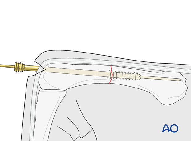 Intramedullary screw fixation of a transverse fracture of a metacarpal shaft – Screw insertion in a retrograde fashion