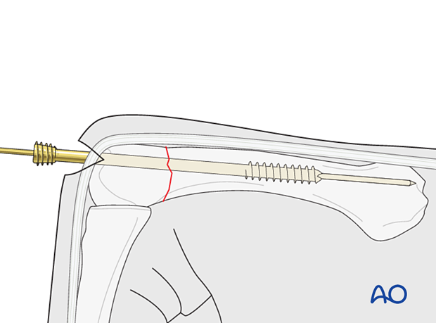 Intramedullary screw fixation of an extraarticular transverse fracture of a metacarpal head – Screw insertion in a retrograde fashion