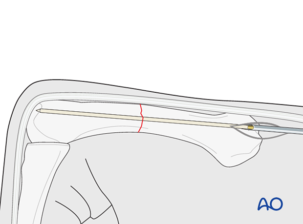 Antegrade intramedullary screw fixation of transverse metacarpal fracture - Guide wire insertion