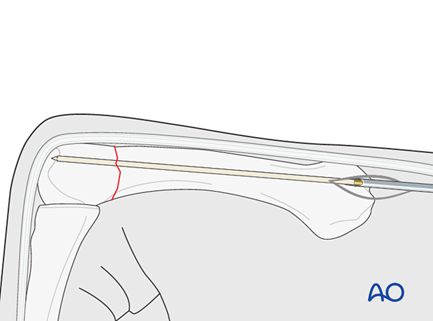 Antegrade intramedullary screw fixation of an extraarticular transverse fracture of a metacarpal head - Guide wire insertion