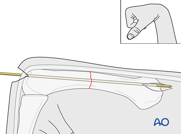 Antegrade intramedullary screw fixation of transverse metacarpal fracture - Guide wire insertion