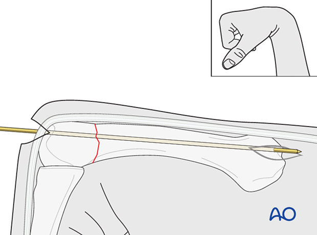 Antegrade intramedullary screw fixation of an extraarticular transverse fracture of a metacarpal head - Guide wire insertion