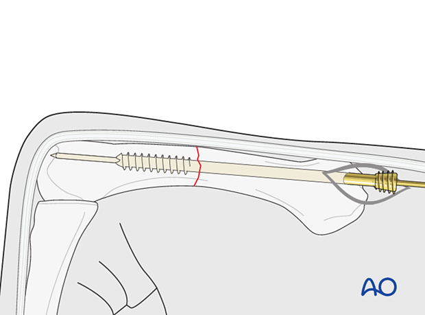 Antegrade intramedullary screw fixation of transverse metacarpal fracture - Screw insertion