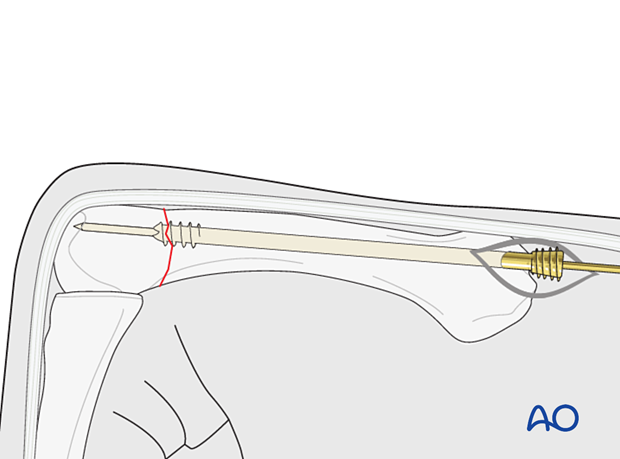 Antegrade intramedullary screw fixation of an extraarticular transverse fracture of a metacarpal head - Screw insertion