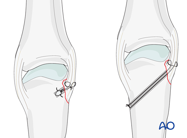 Suture anchor and bone tunneling techniques for collateral ligament reattachment of an avulsion fracture of the metacarpal head