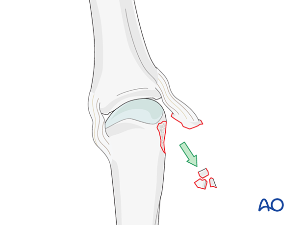 Small fragments removal – collateral ligament reattachment of an avulsion fracture of the metacarpal head