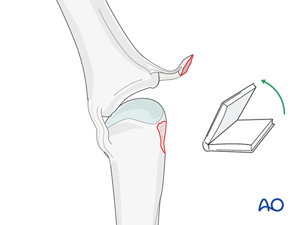 Phalanx laterally deviated to visualize joint – collateral ligament reattachment of an avulsion fracture of the metacarpal head