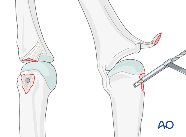 AP and lateral view of drilling the anchor hole – collateral ligament reattachment of an avulsion fracture of the metacarpal head