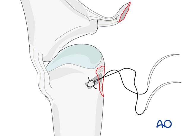 Anchor inserted in anchor hole – collateral ligament reattachment of an avulsion fracture of the metacarpal head