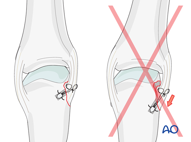 Correct, anatomic versus incorrect, nonanatomic placement anchor sutures – collateral ligament reattachment of an avulsion fracture of the metacarpal head