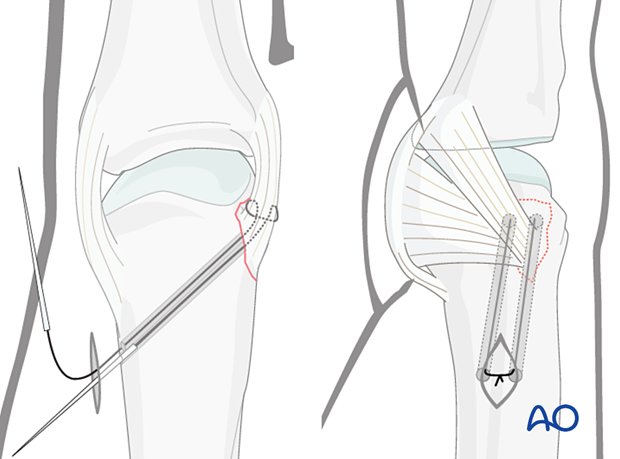 Suture retrieval and knotting – collateral ligament reattachment of an avulsion fracture of the metacarpal head