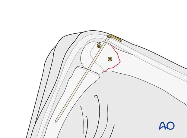 Transfixation of the 2nd metacarpophalangeal joint with a K-wire