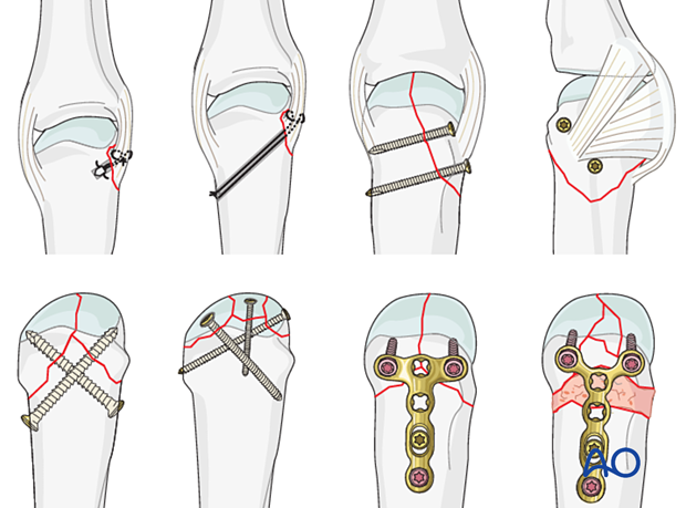 Open reduction and fixation for the management of articular metacarpal head fractures