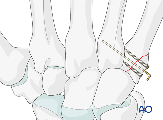 Lag-screw fixation of a partial articular fracture of the 5th metacarpal base with CMC joint stabilization