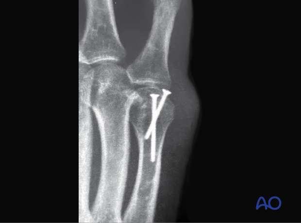 severe inflammatory reaction and cartilage compromise in a 5th metacarpal head fracture with screw fixation