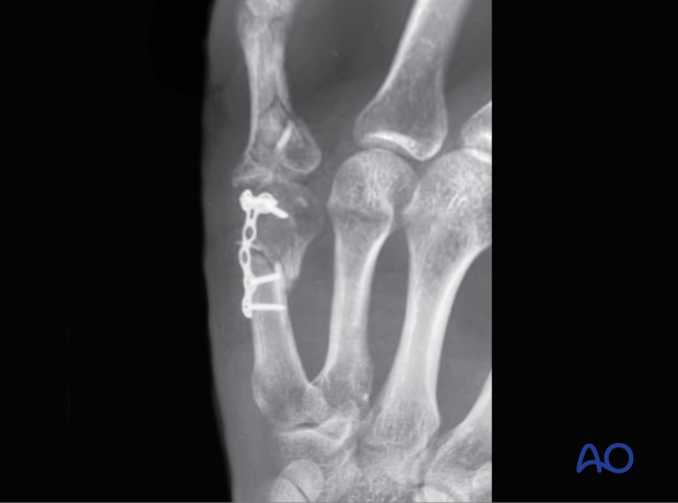  intraarticular fracture of the 5th proximal phalangeal neck with insufficient reduction and stabilization leading to plate failure and nonunion