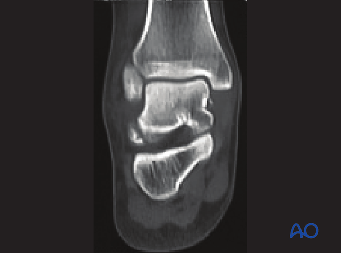 Lateral Processes Lateral process