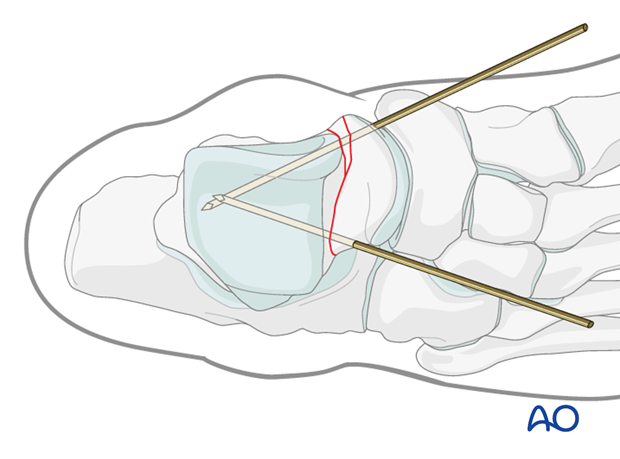 Preliminary fixation