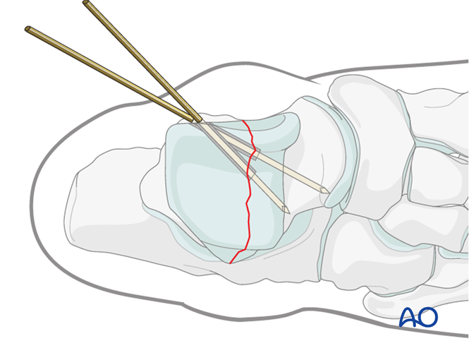 ORIF - Screw and plate fixation for Body