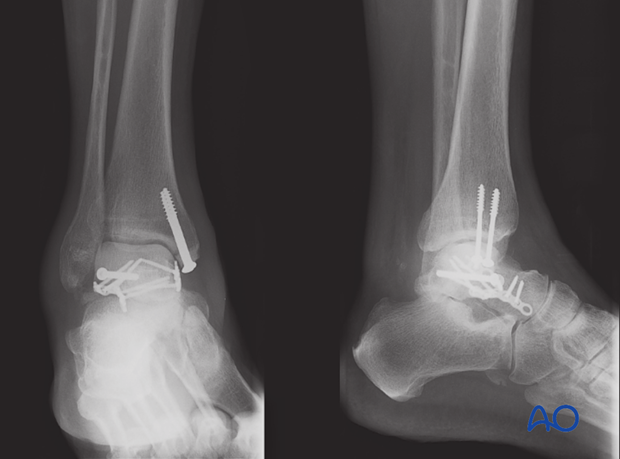 orif screw and plate fixation