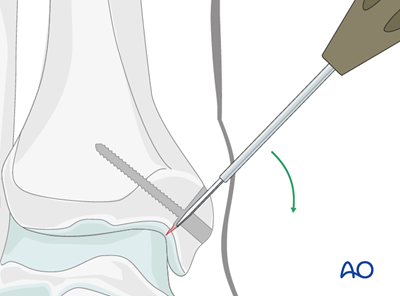 Medial malleolar osteotomy