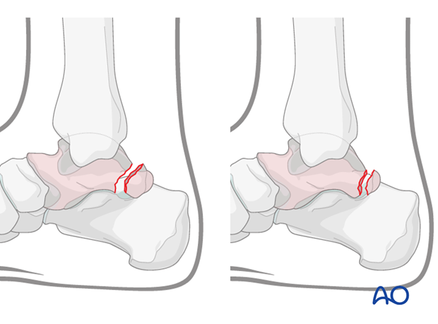 Fractures of the posterior process of the talus 