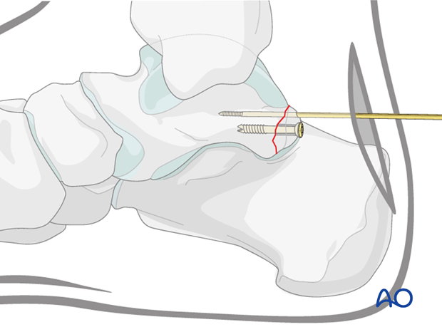 Screw insertion