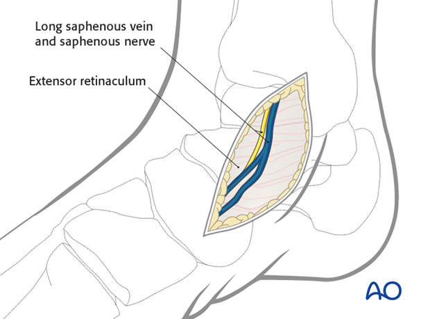 anteromedial approach to the talus