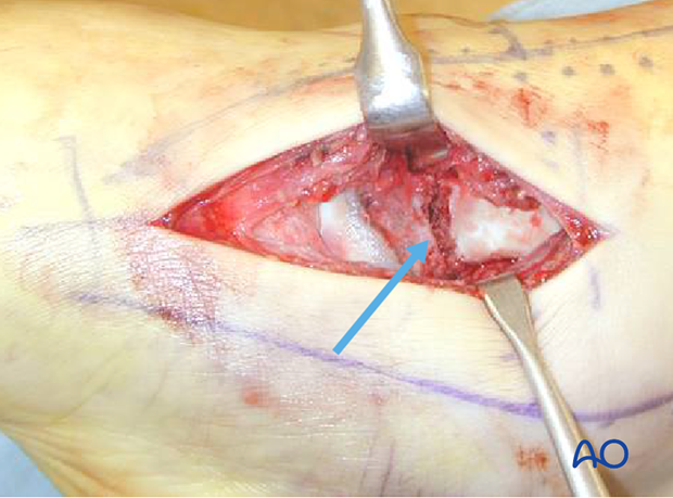 anteromedial approach to the talus