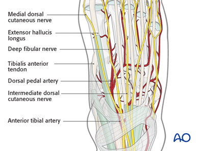 Anteromedial approach to the talus