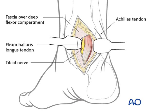 posteromedial approach to the talus