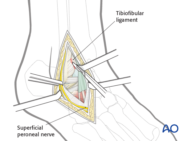 lateral malleolar osteotomy