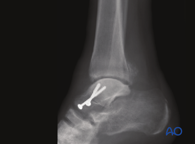 Winchester Toothpick Brown Checkered Bone KB111W / WN19102C main image 0