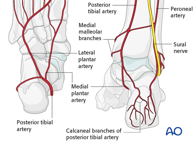 Extended lateral approach to the calcaneus