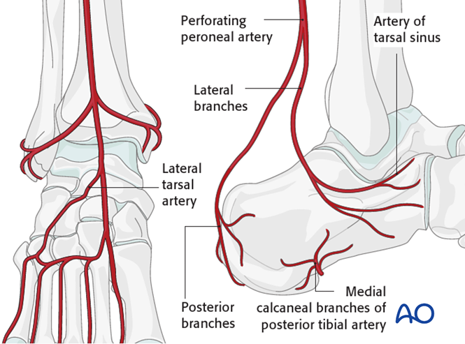 Extended lateral approach to the calcaneus