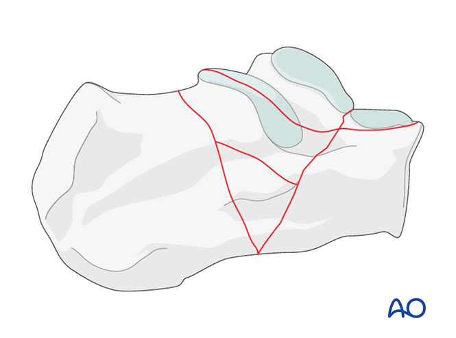 Extreme tongue-type (beak) fracture of the calcaneus body