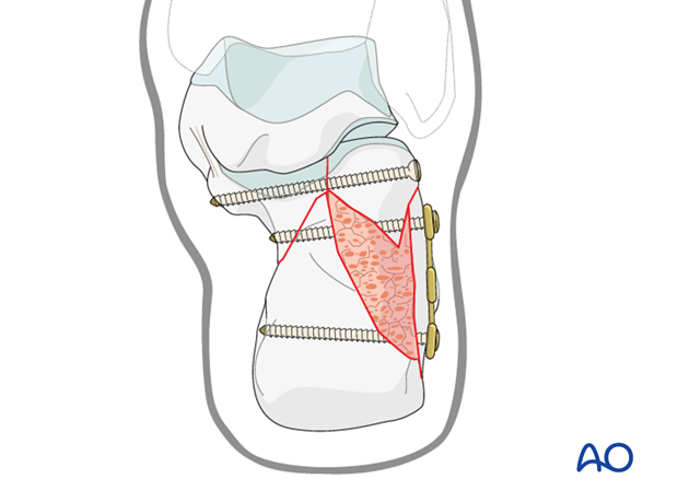 orif plate and screw fixation