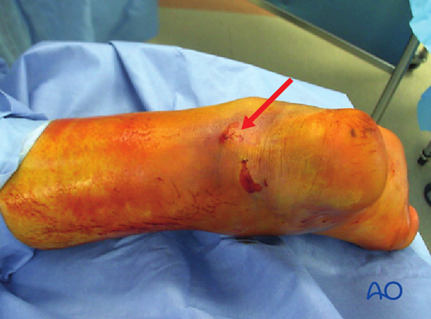 Arrow points to compromised posterior skin