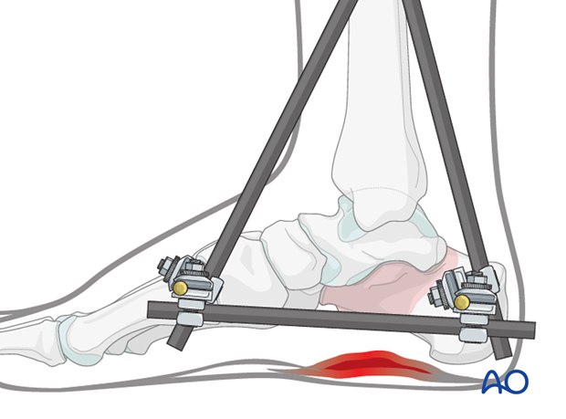 open fractures