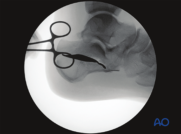 mio k wire and screw fixation joint depression type